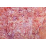 Stick-On Medium Ulcerierendes Mamma-CA (Brusttumor)