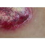 Stick-On Medium Ulcerierendes Mamma-CA (Brusttumor)
