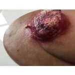 Stick-On Medium Ulcerierendes Mamma-CA (Brusttumor)