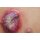 Stick-On Medium Ulcerierendes Mamma-CA (Brusttumor)