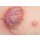 Stick-On Medium Ulcerierendes Mamma-CA (Brusttumor)