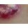 Stick-On Medium Ulcerierendes Mamma-CA (Brusttumor)