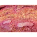 Large Chronic Wound