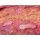 Large Chronic Wound