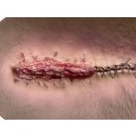 Stick-On Medium OP Wunde geöffnet - saubere Wunde