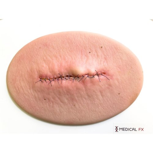 Surgical wound model sutured