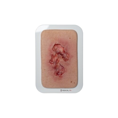 Pocketwound Ulcer - Chronic Wound - clean wound, light