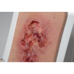 Pocketwound Ulcer - Chronic Wound - clean wound, light