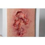 Pocketwound Ulcer - Chronic Wound - clean wound, light