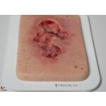 Pocketwound Ulcer - Chronic Wound - clean wound, light