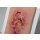 Pocketwound Ulcer - Chronic Wound - clean wound, light