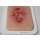 Pocketwound Ulcer - Chronic Wound - clean wound, light