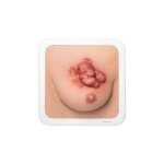 Frame Model Ulcerating Breast CA (breast tumor)