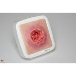 Frame Model Pressure Ulcer with Smooth Wound Edge - clean wound, light