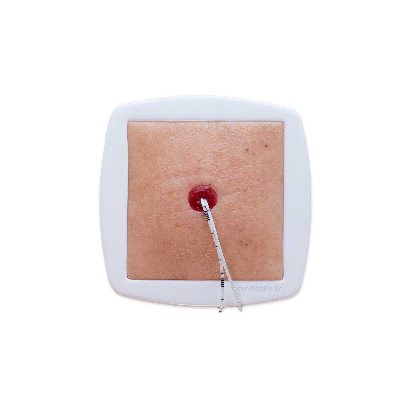 Stoma Inversion Tool Stoma at skin level model MEDICAL FR15-05-0042-00-1