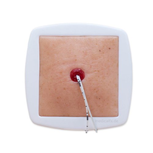 Stoma at skin level model