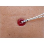 Stoma at skin level model