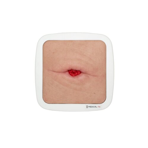Rahmenmodell Stoma in einer Hautfalte - hell