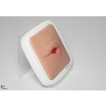 Rahmenmodell Stoma in einer Hautfalte - hell