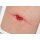Rahmenmodell Stoma in einer Hautfalte - hell