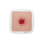 Rahmenmodell Stoma mit Nahtdehiszenz - hell