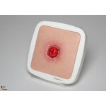 Rahmenmodell Stoma mit Nahtdehiszenz - hell