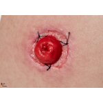 Frame Modell Stoma with suture dehiscence