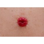 Frame model Stoma Perfect - light