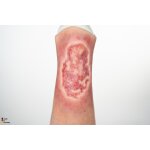 Sleeve Bein mit Ulcus Cruris -  saubere Wunde, hell