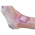 Base model leg with 7 deep wounds