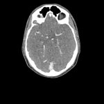Kopf und Hals Phantom für CT, Röntgen und Strahlentherapie