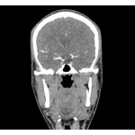 Kopf und Hals Phantom für CT, Röntgen und Strahlentherapie