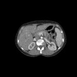 Abdomen phantom for CT, X-ray and radiation therapy