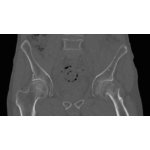 Pelvic phantom with femoral neck fracture for CT, X-ray and radiation therapy