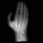 Handphantom für CT, Röntgen und Strahlentherapie