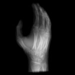 Hand phantom for CT, X-ray and radiation therapy