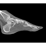 Foot phantom for CT, X-ray and radiation therapy
