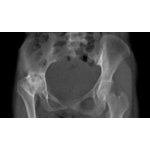 Pelvic phantom with coxarthrosis for CT, X-ray and radiation therapy