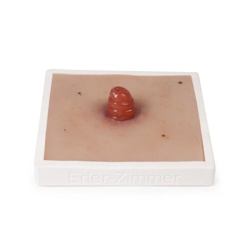Wundmoulage Ileostoma, inkl. Stativ