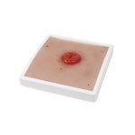 Wound Moulage Colostoma, incl. stand