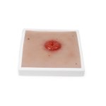 Wundmoulage Kolostoma