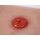 Wundmoulage Kolostoma