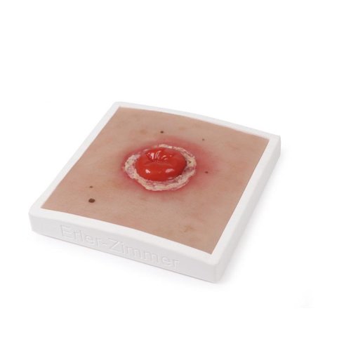 Wound Moulage Colostoma, inflamed