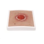 Wound Moulage Colostoma, inflamed
