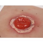 Wound Moulage Colostoma, inflamed