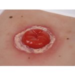 Wound Moulage Colostoma, inflamed
