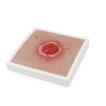 Wound Moulage Colostoma, inflamed