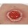 Wound Moulage Colostoma, inflamed