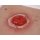 Wound Moulage Colostoma, inflamed