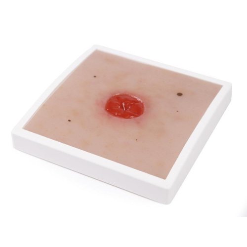 Wundmoulage Kolostoma, unter Hautniveau